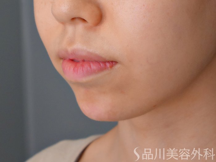 症例NO.70454のAFTER写真