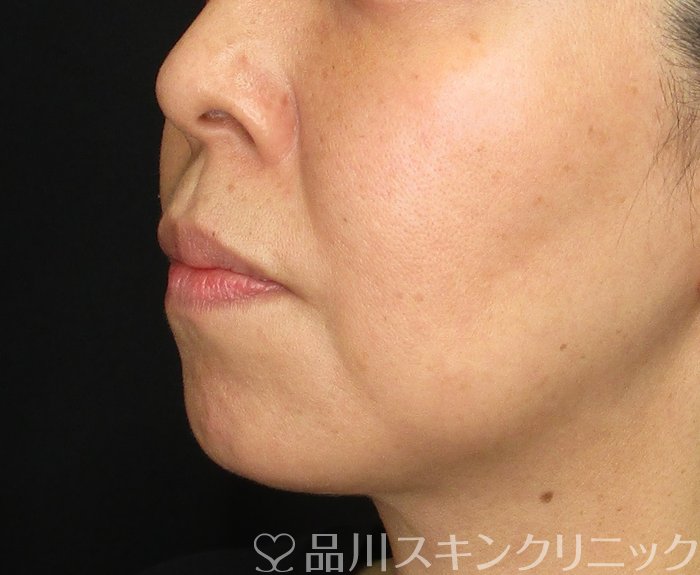 症例NO.73248のBEFORE写真