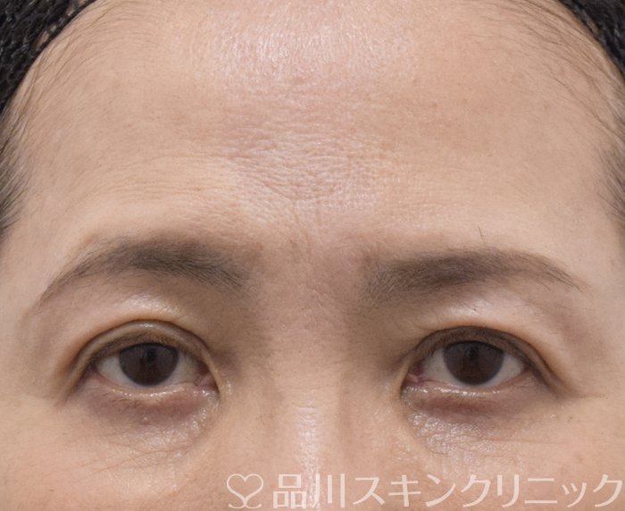 症例NO.71384のAFTER写真