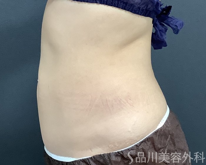 症例NO.75347のAFTER写真