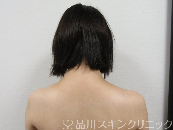症例NO.75219のAFTER写真