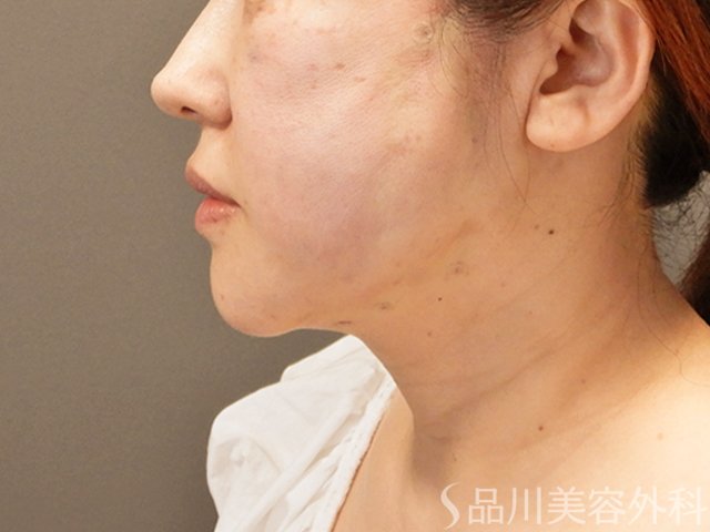 症例NO.70932のAFTER写真