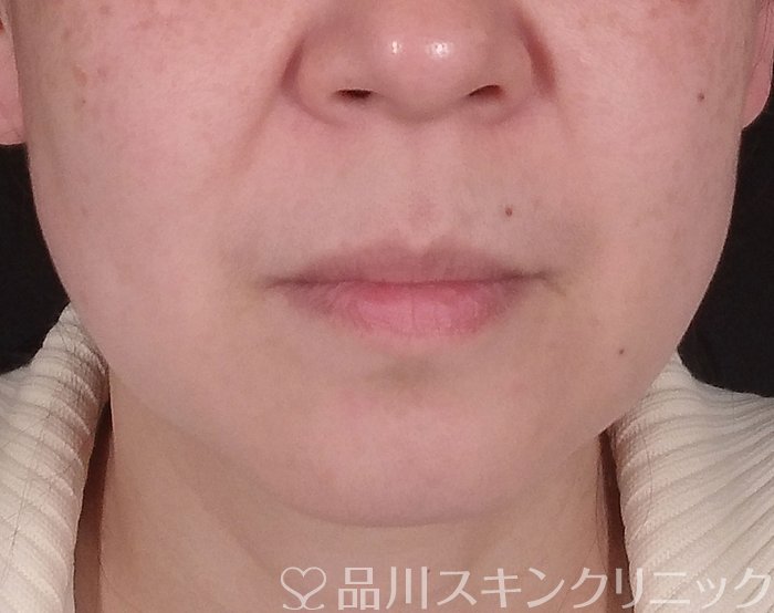 症例NO.69543のBEFORE写真
