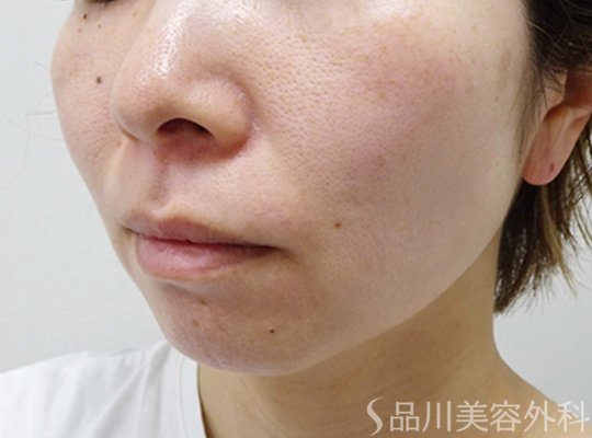 症例NO.74061のAFTER写真