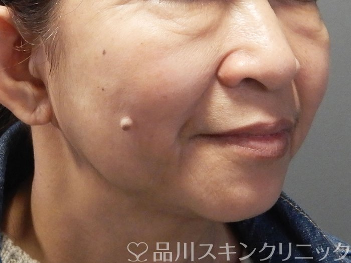 症例NO.72395のBEFORE写真