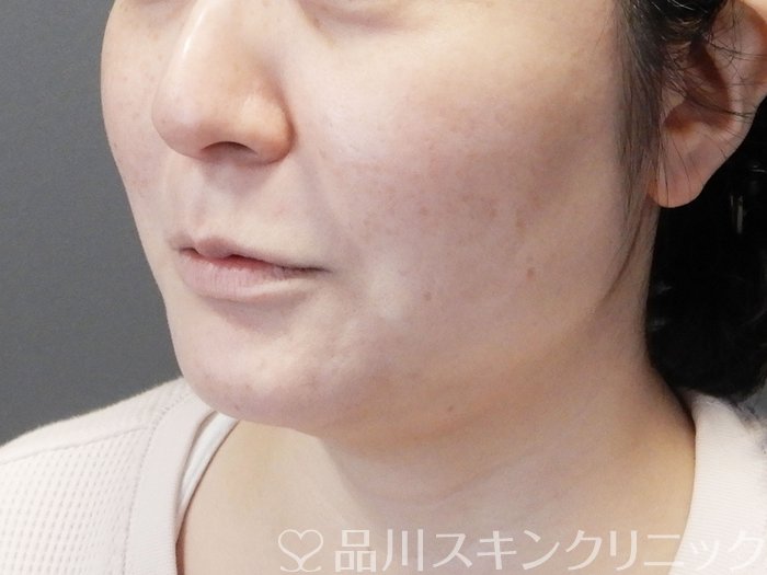 症例NO.73382のBEFORE写真