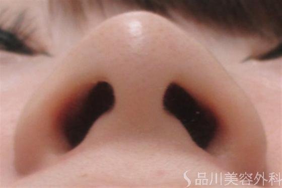 症例NO.14485のBEFORE写真
