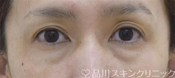 症例NO.52545のBEFORE写真