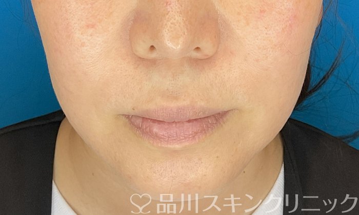 症例NO.74826のBEFORE写真