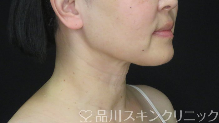 症例NO.71779のBEFORE写真