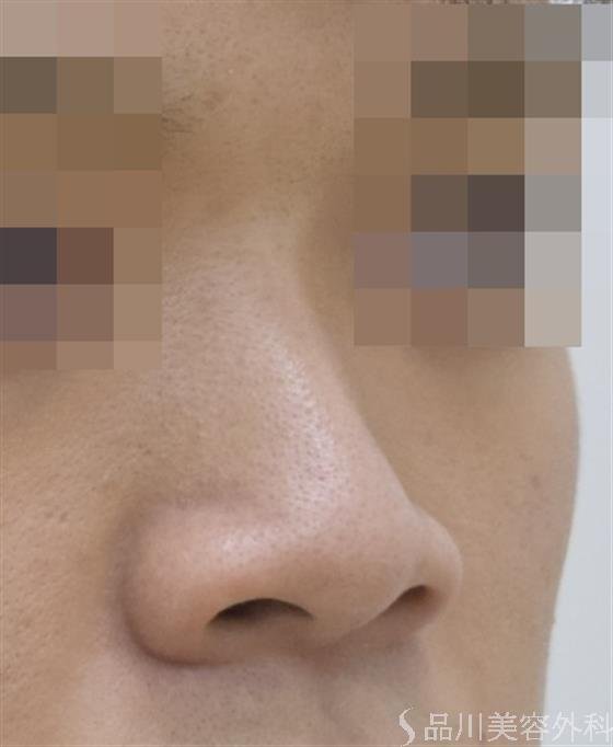 症例NO.48137のBEFORE写真