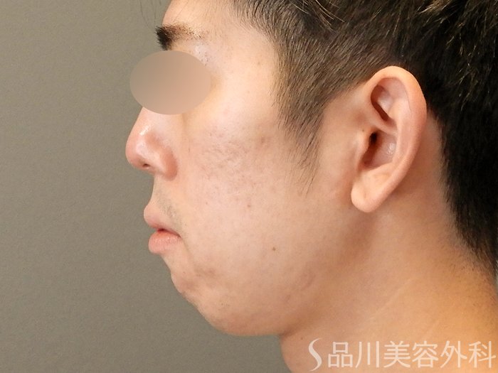 症例NO.67619のAFTER写真