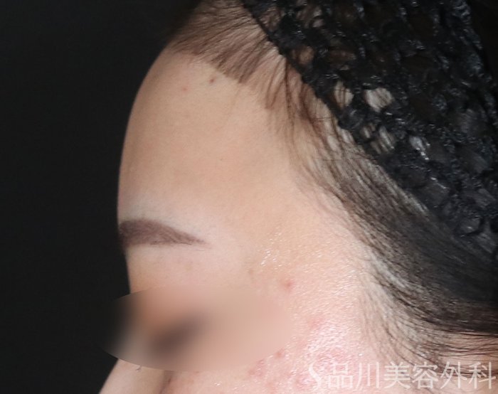 症例NO.73406のAFTER写真