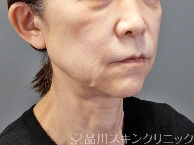症例NO.67418のBEFORE写真