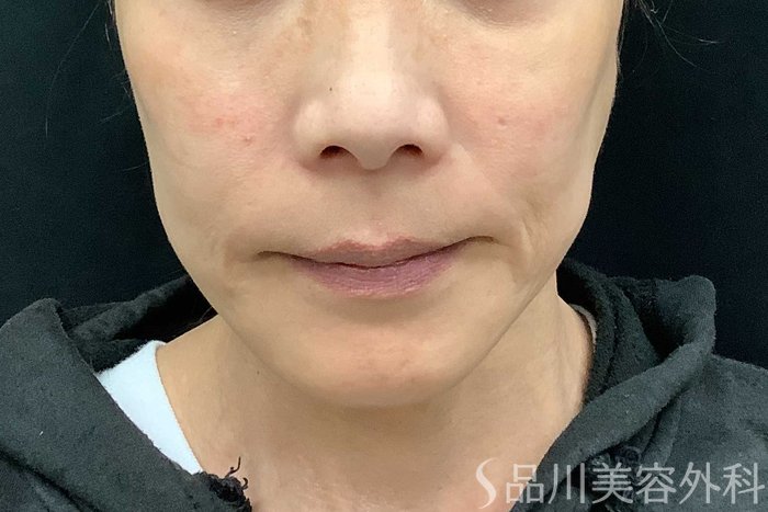 症例NO.71108のBEFORE写真