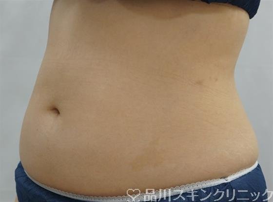 症例NO.48439のAFTER写真