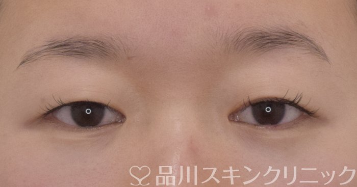 症例NO.69571のBEFORE写真