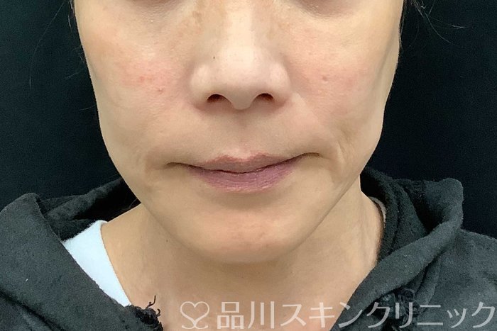 症例NO.71108のBEFORE写真