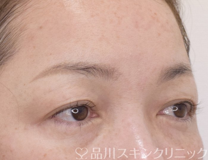 症例NO.73993のBEFORE写真