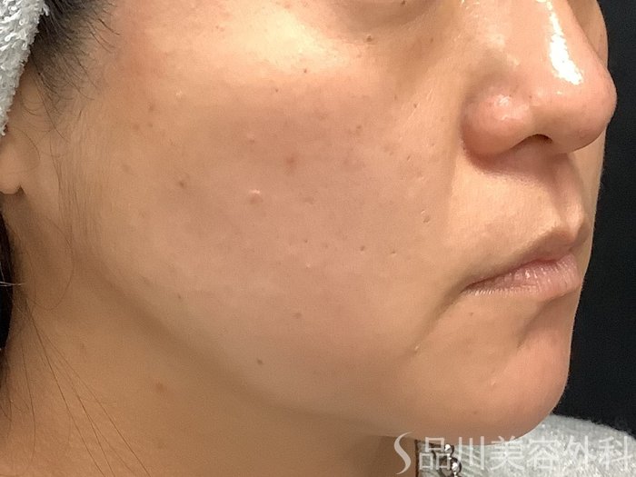 症例NO.67793のBEFORE写真