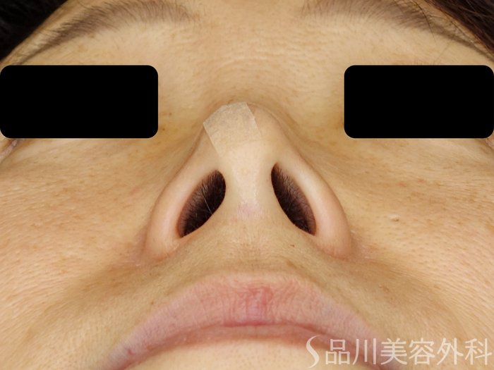 症例NO.71408のAFTER写真