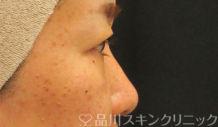 症例NO.72981のBEFORE写真