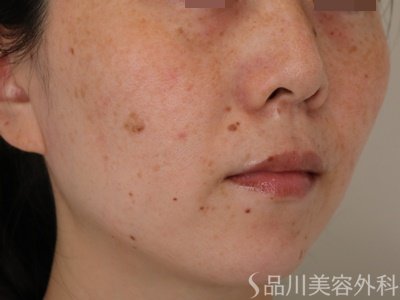 症例NO.70925のBEFORE写真