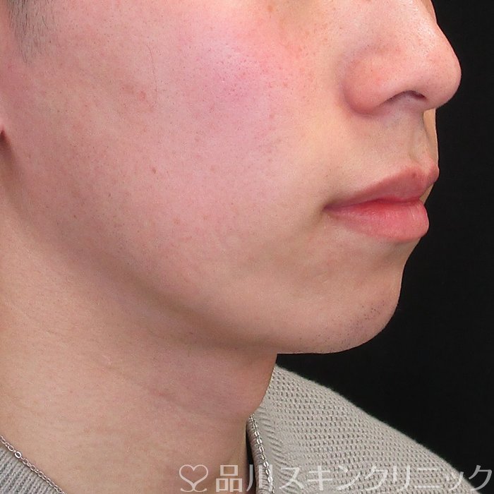 症例NO.73728のBEFORE写真