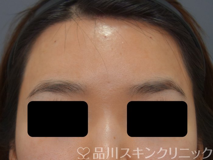 症例NO.73444のAFTER写真