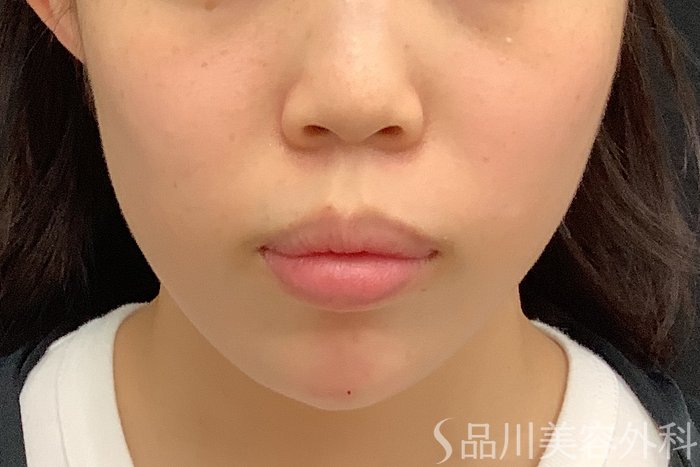 症例NO.71585のAFTER写真