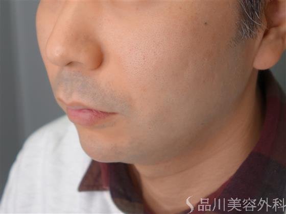 症例NO.53677のAFTER写真