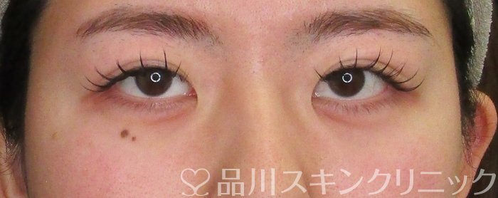 症例NO.69978のAFTER写真