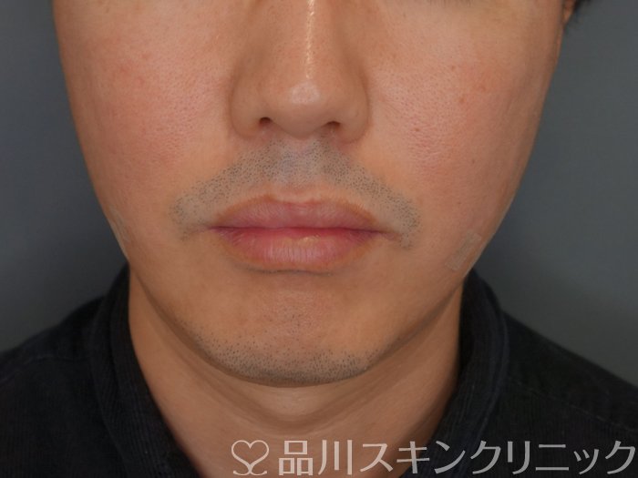 症例NO.75309のAFTER写真