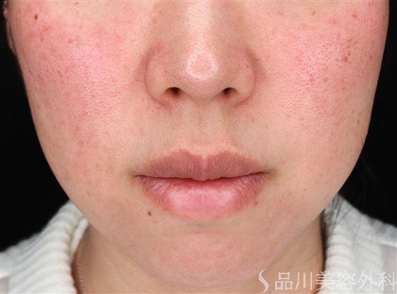 症例NO.61932のBEFORE写真