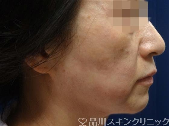 症例NO.32761のAFTER写真