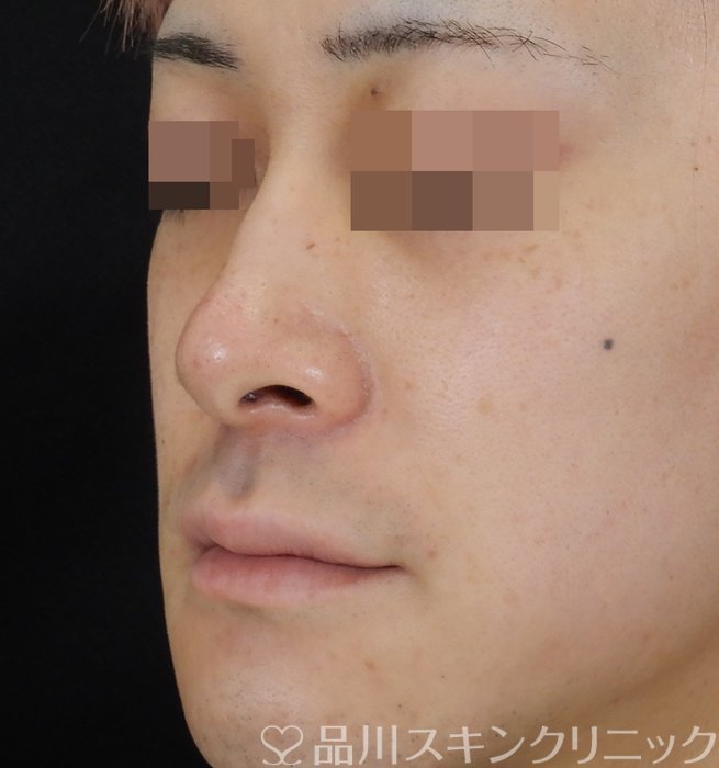 症例NO.65975のAFTER写真