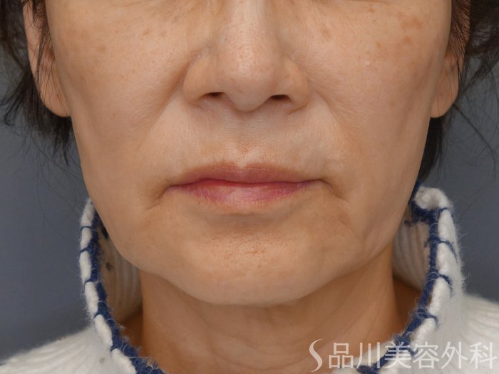 症例NO.69359のBEFORE写真