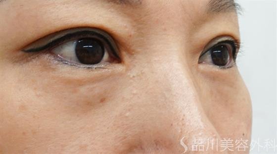 症例NO.46605のBEFORE写真