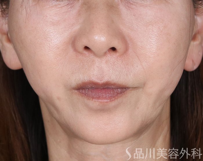 症例NO.73737のAFTER写真