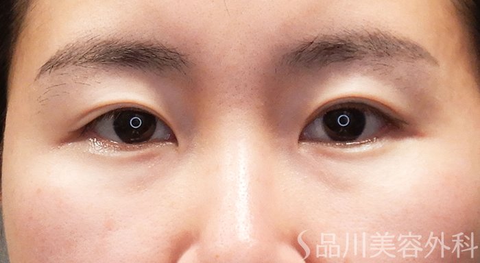 症例NO.69334のBEFORE写真