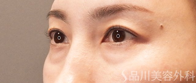 症例NO.71085のBEFORE写真