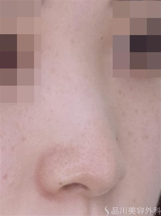 症例NO.49318のBEFORE写真