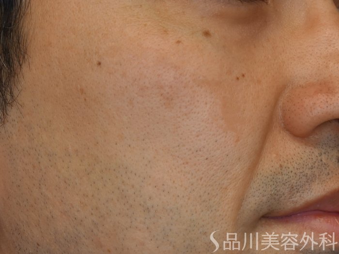 症例NO.74814のAFTER写真