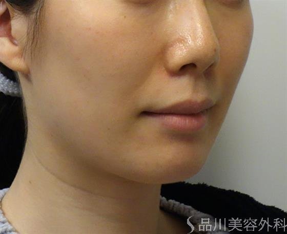 症例NO.39899のBEFORE写真