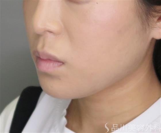 症例NO.48180のBEFORE写真