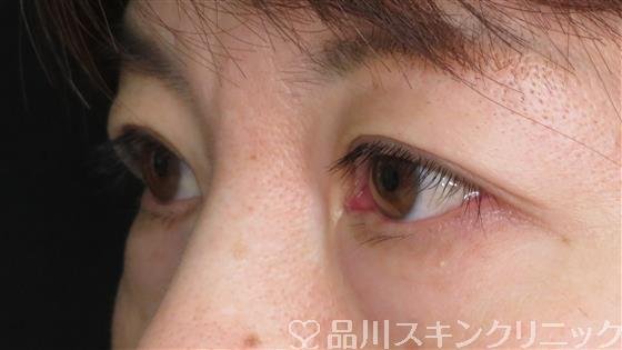 症例NO.49980のBEFORE写真