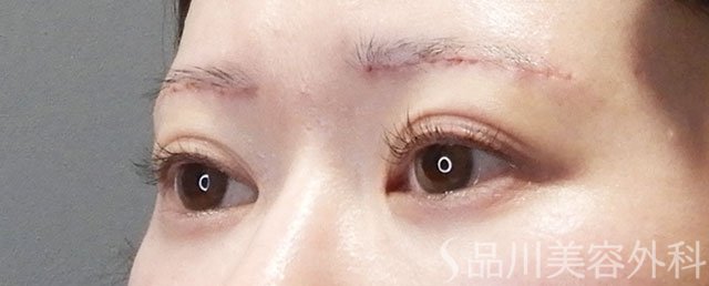 症例NO.73106のAFTER写真