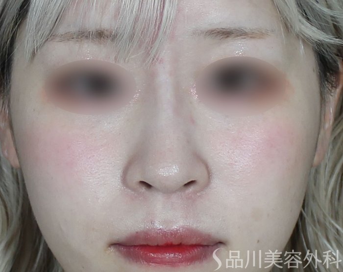 症例NO.69657のAFTER写真
