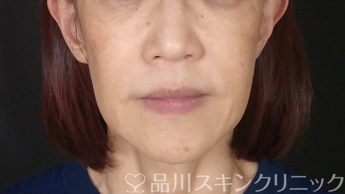 症例NO.72477のBEFORE写真