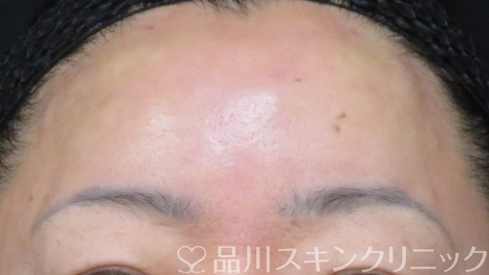 症例NO.71367のAFTER写真